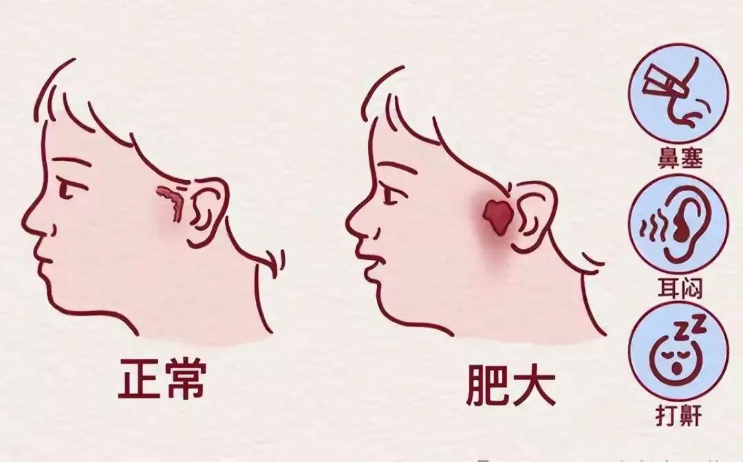 孩子腺样体、扁桃体肥大，这个中成药一定是绕不过去的！孩子腺样体、扁桃体肥大，很