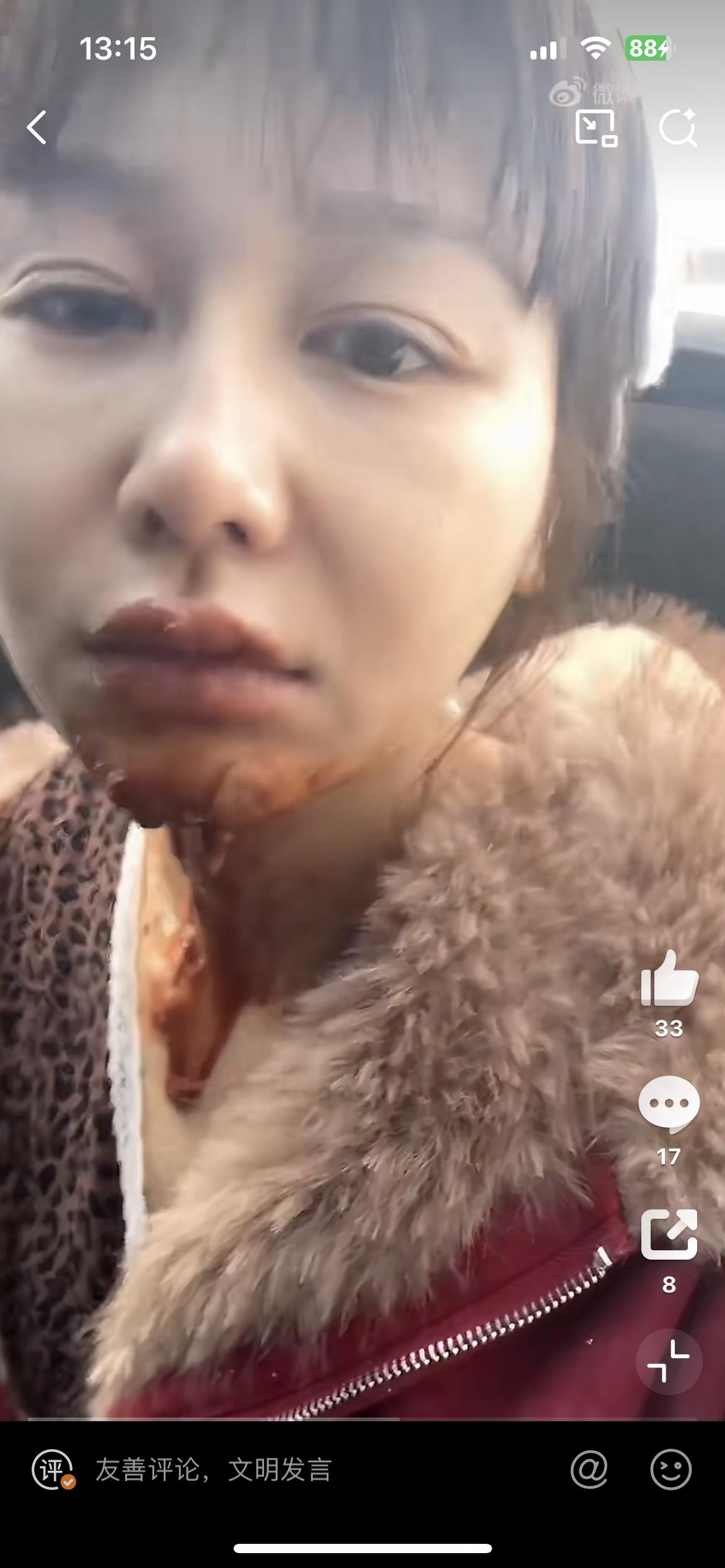 尴尬了，演员王添羽生日表演喷火被烧伤，差点毁容。看她拍的视频，一手端着生日蛋糕，