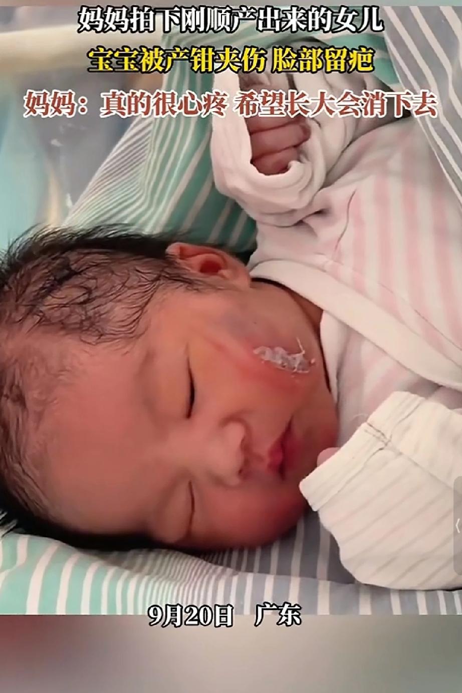 妈妈拍下刚顺产出来的女儿，宝宝被钳夹伤脸部留疤，真的很心疼希望长大会消下去！