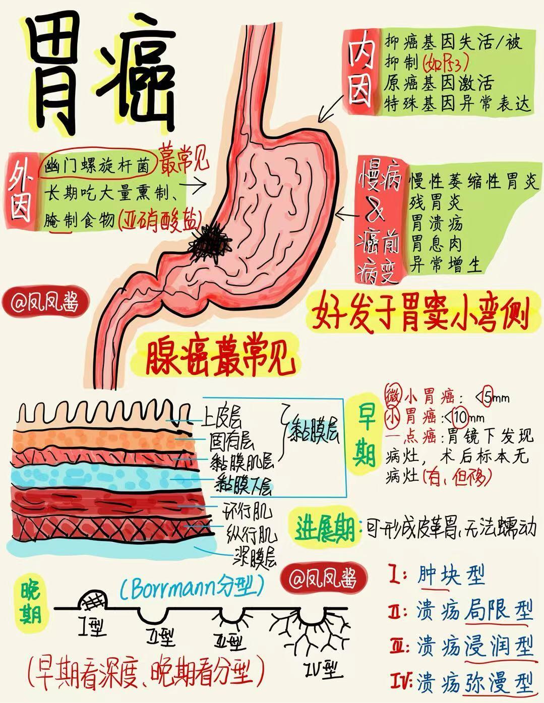 📖医学生笔记｜胃癌建议点赞收藏🔥