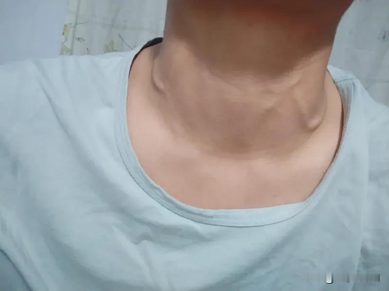 甲亢早期症状颇为多样。代谢上，患者怕热多汗、皮肤暖湿，或有低热、体重减轻，有人食