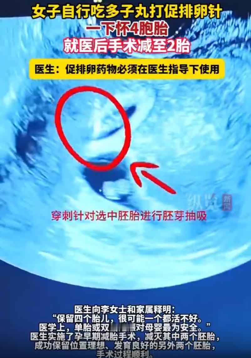 江苏淮安，女子结婚后一直没能怀上孩子，她自行吃“多子丸”并注射促排卵针，虽然成功