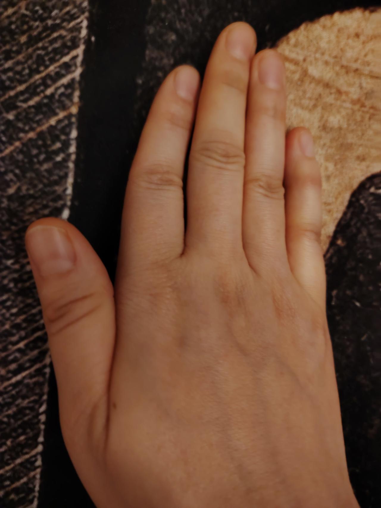 阿育吠陀认为健康人拇指月牙＞食指＞中指＞无名指＞小指，逐级缩小，是气血能量自上而