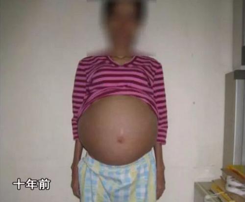 吃偏方后女子26岁大了肚子, 却一直挺着肚子到了36, 还不是怀孕