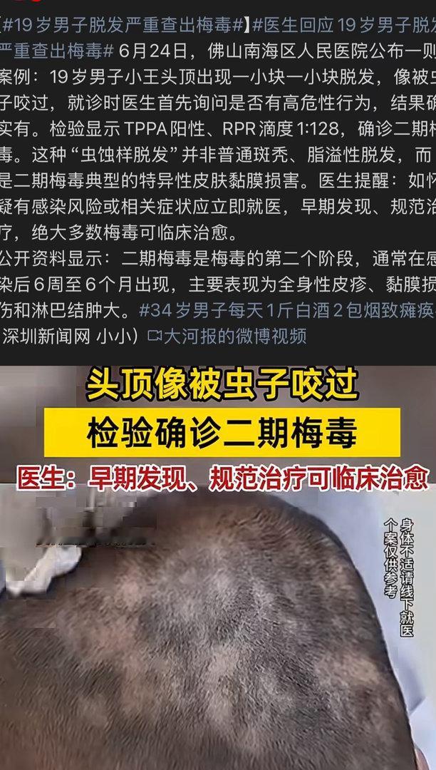 19岁男子脱发严重查出梅毒9命！！！19岁的小伙子到底干了啥。