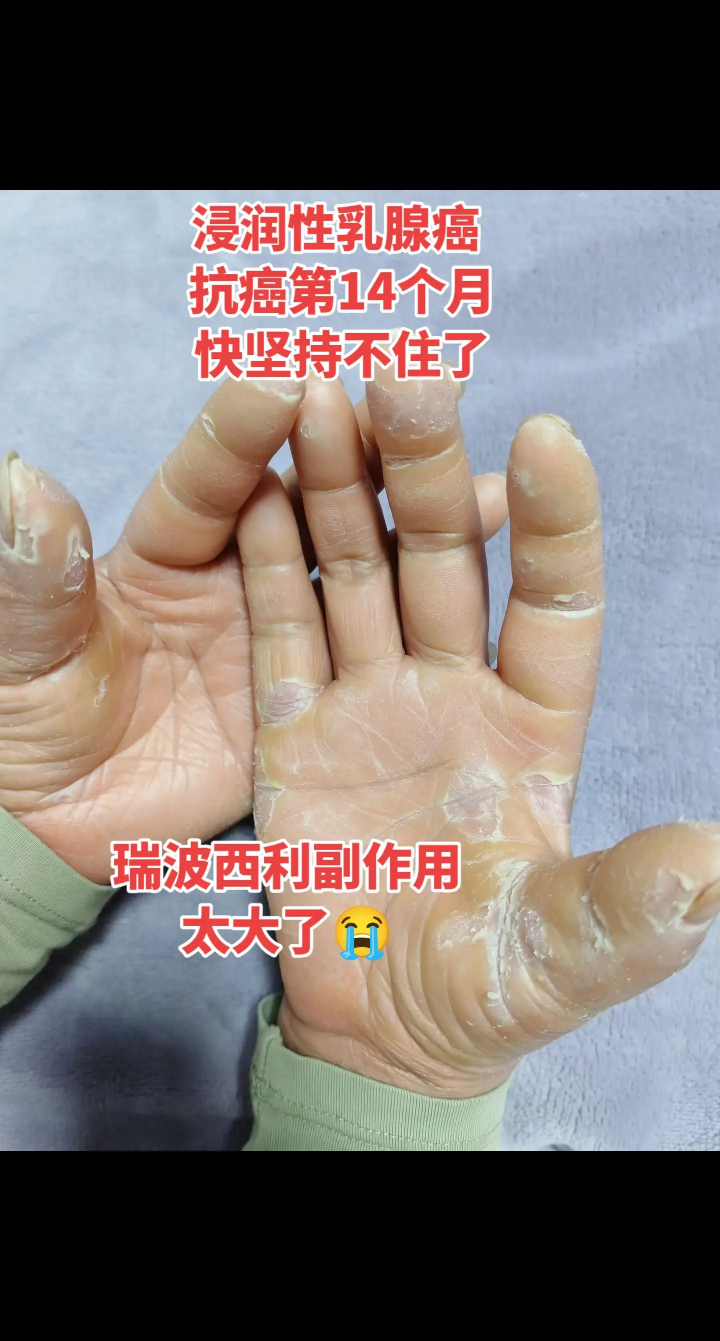 浸润性乳腺癌，中晚期！液窝淋巴清扫转移，抗癌第14个月了，内分泌治疗...