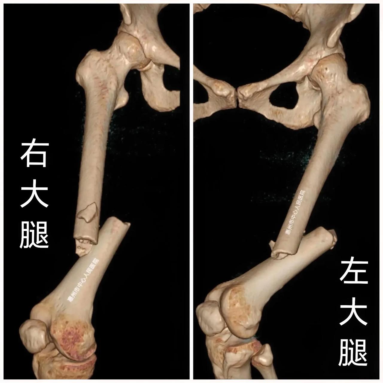 大过年！😡高速追尾，大腿骨骨折！春节期间，开车回家，探亲访友，都是高