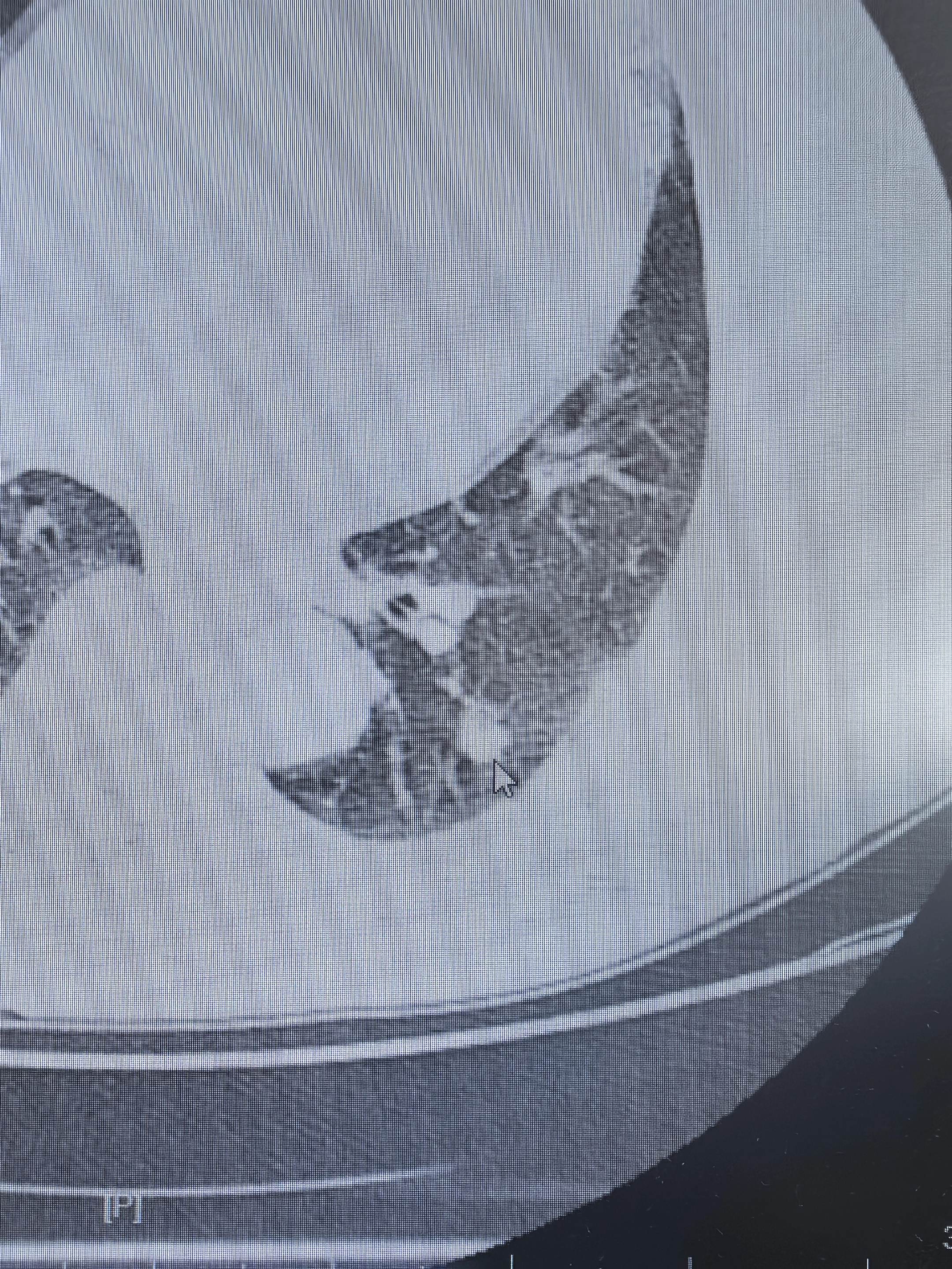 左下肺实性肺癌。左下肺实性肺癌，清扫了第4-14组淋巴结……对于实性的...