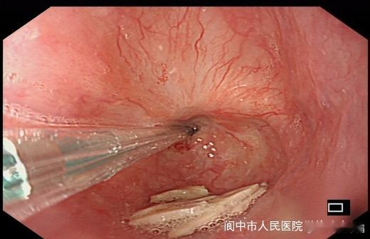 食管球囊扩张术内镜直视设备引导下将球囊置于食管狭窄处，通过注水扩张球囊，使食管狭