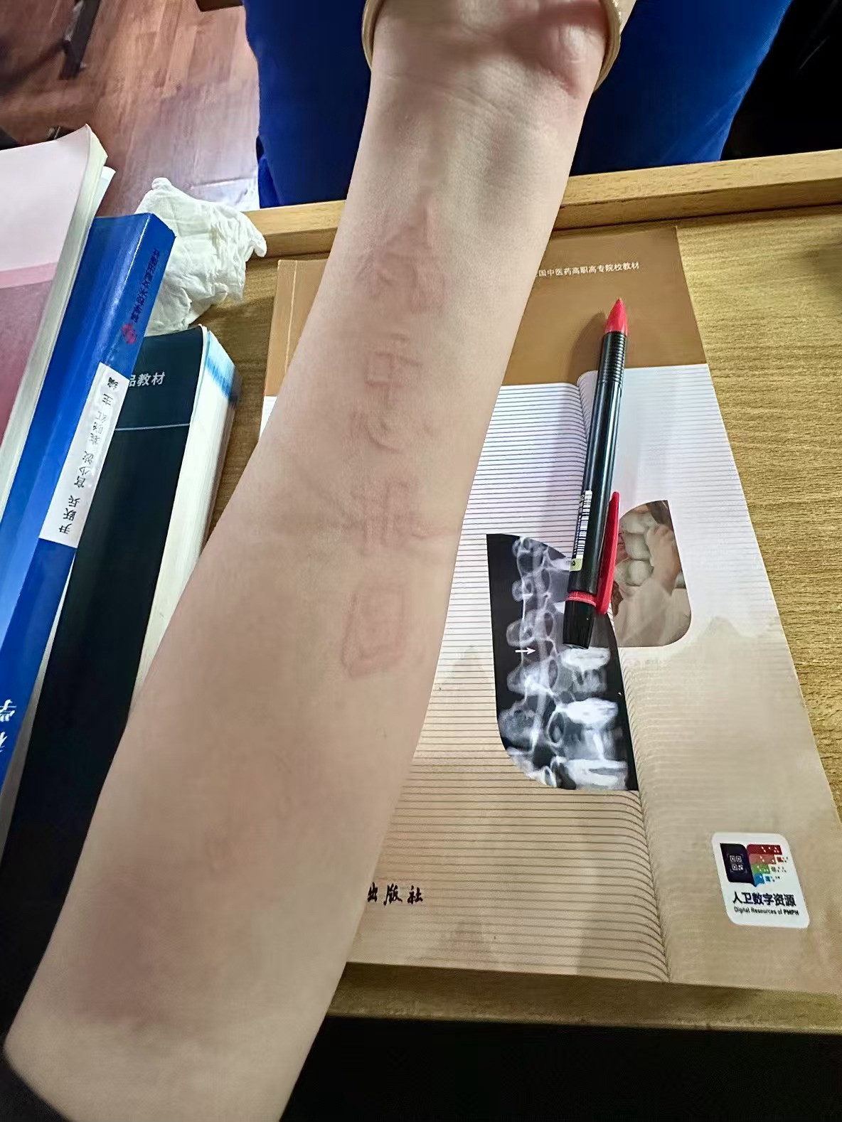 如果你问我什么是划痕性寻麻疹的话[作揖]​​​