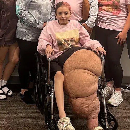经历了12年的病痛折磨后，这位14岁的少女在经历了17个小时的手术后，不得不截去