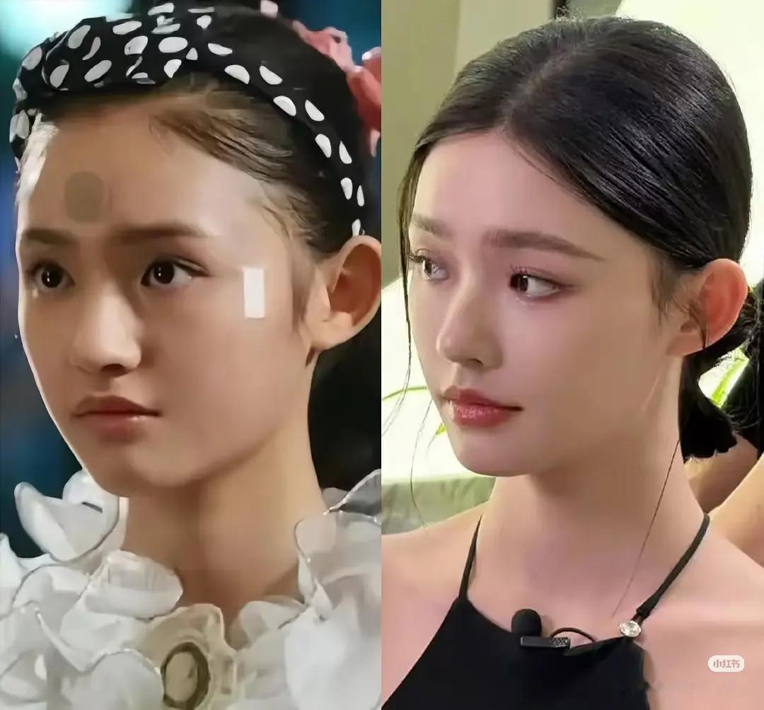 林允以前真的很丑吗