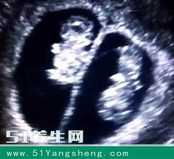 做B超是两个女儿, 婆婆叫我打掉, 生后求我让她看孩子, 已经晚了