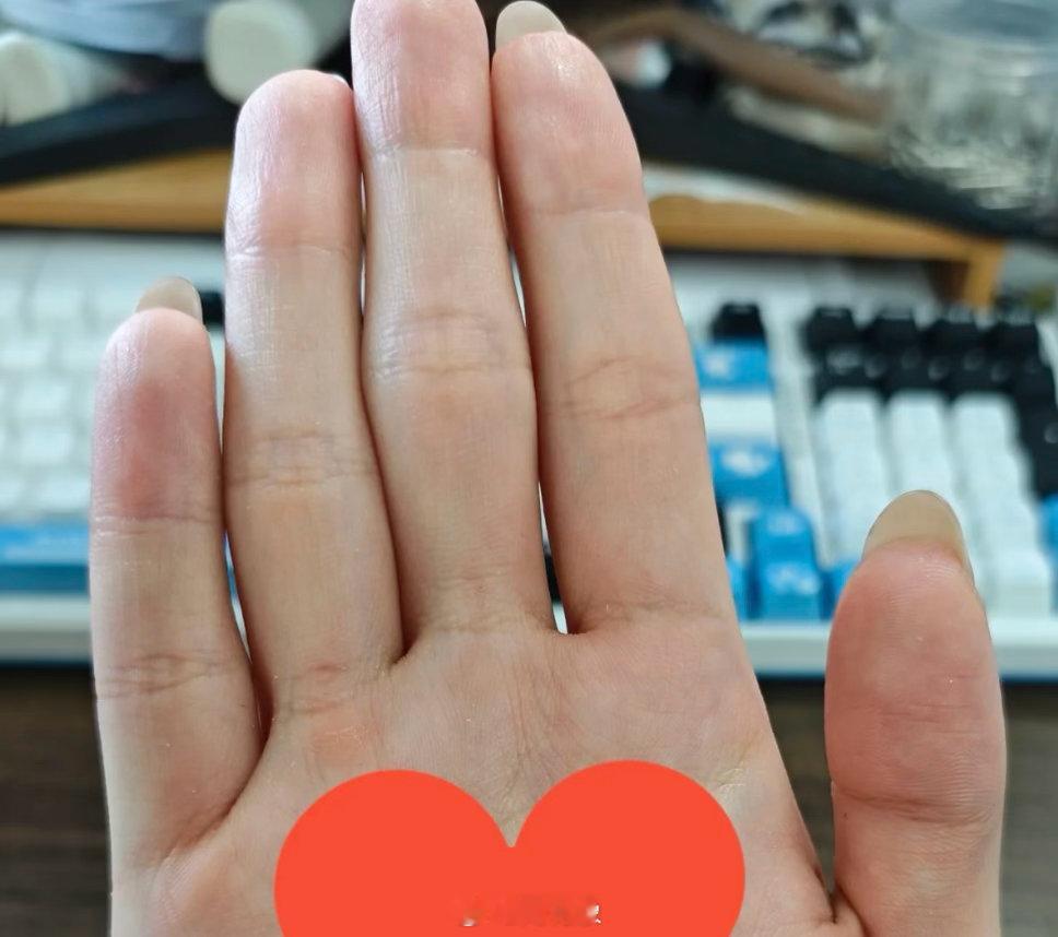 手指有漏，对应易漏米，脾胃不太好，肠道吸收弱。吃了很多食物，只吸收一点点，那可不