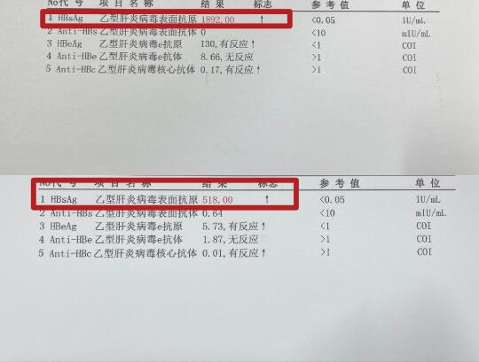 济南的一位乙肝女士，长期规范治疗后，本次复查肝功能恢复正常，病毒量低于...