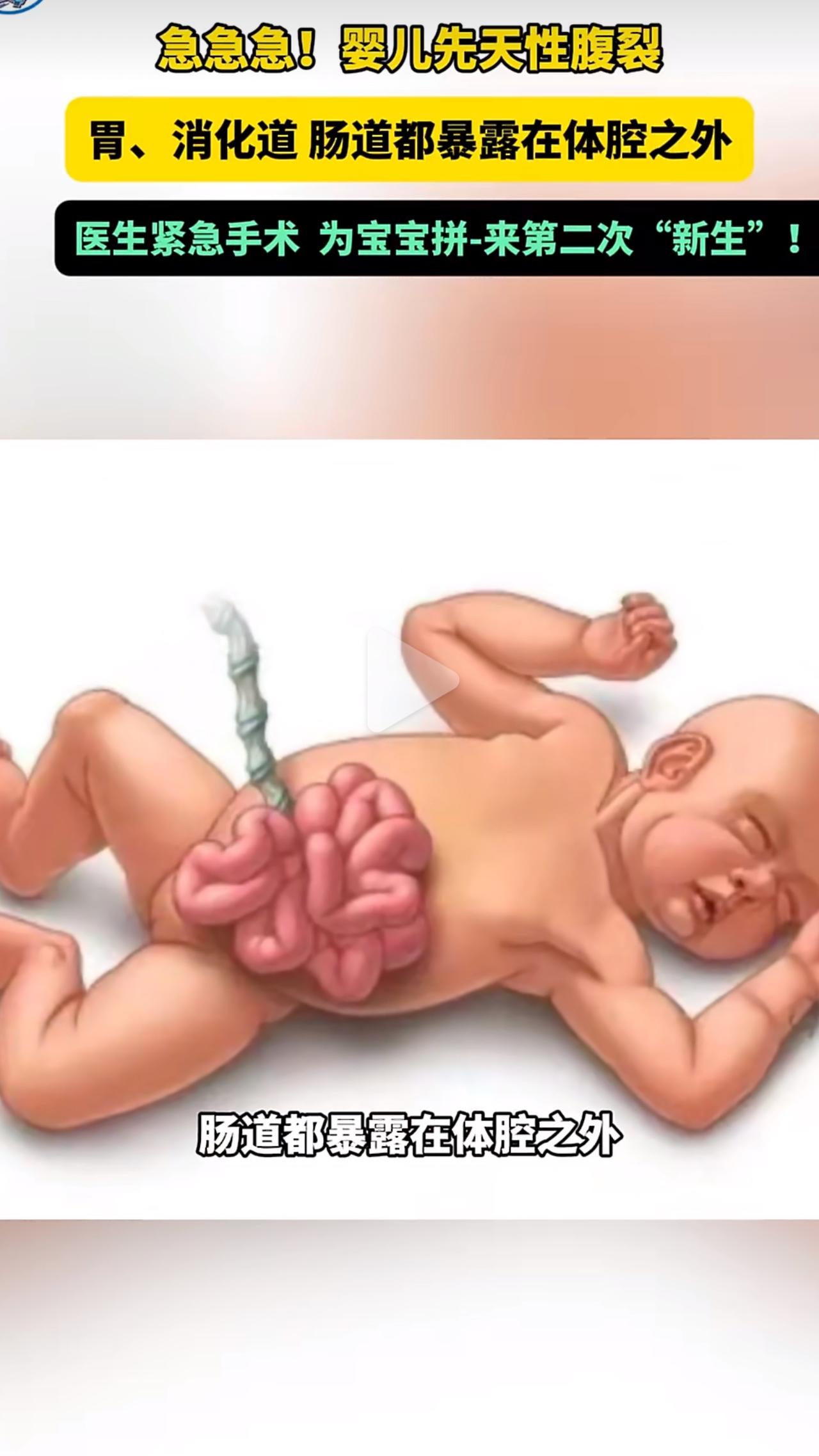 一则关于新生儿的消息让无数人揪心又感动，一个刚出生的小宝宝，肚皮上竟然裂开了一道