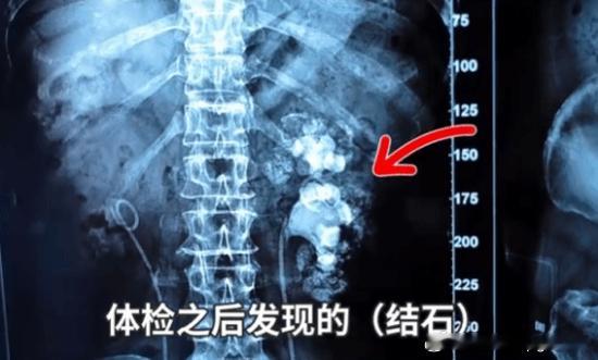 9年喝了3000杯奶茶发现时双肾已长满结石湖南长沙一位肖女士八九年前曾确诊肾结