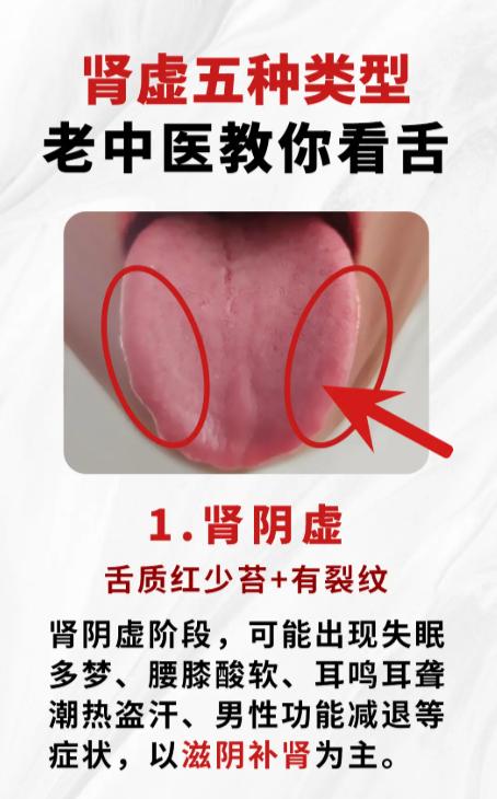 肾虚分5种！老中医教你怎么看舌象辨类型