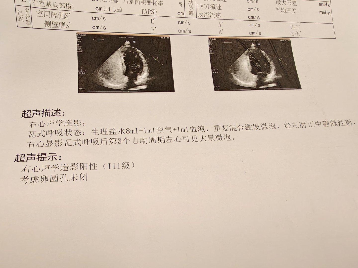 去医院查了一下，还真是卵圆孔未闭合就是左右心房中间有个洞照理说应该封上，但实际