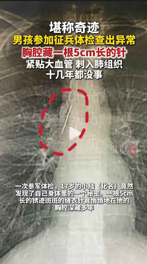 “命真大啊！”近日，一位17岁少年满心欢喜的去报名参军，可体检的时候却出了问题，