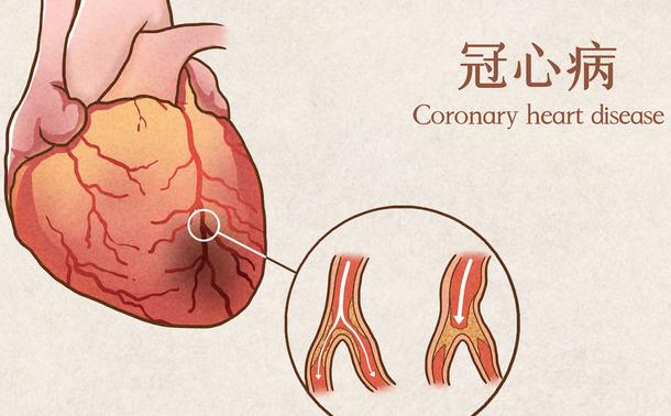 在中医体系中，冠心病多归为“胸痹”“心痛”范畴，其发病根本在于“本虚标实”