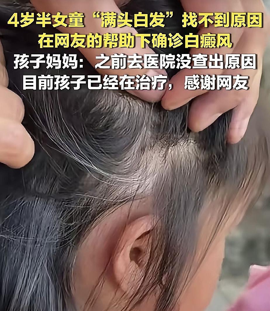 全网破防！4岁娃莫名长满头白发，各项体检全部正常，全靠网友救命养娃路上