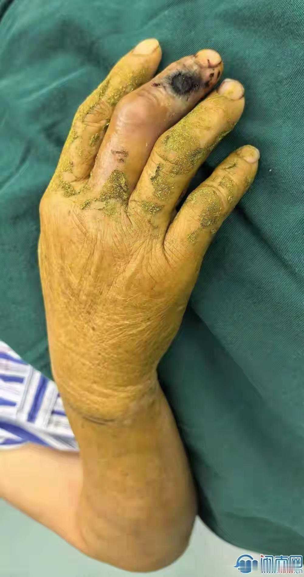 53岁阿姨被2米眼镜蛇咬手，竟单手生擒当“活标本”送医！医生惊呼：这是教科