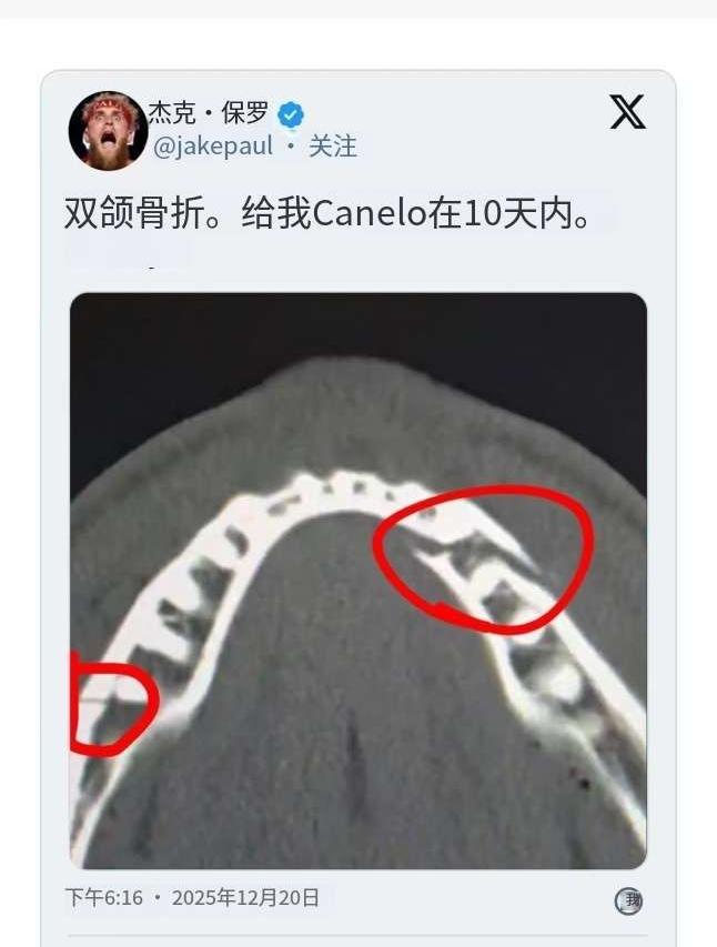 约书亚那一拳直接把保罗下巴打骨折了。网红是网红，职业是职业，保罗也就是能打打老