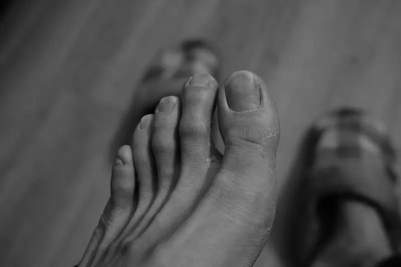 痛风能不能彻底治好，这是个让人纠结的问题。目前来说，痛风很难被彻底根治。痛风主要