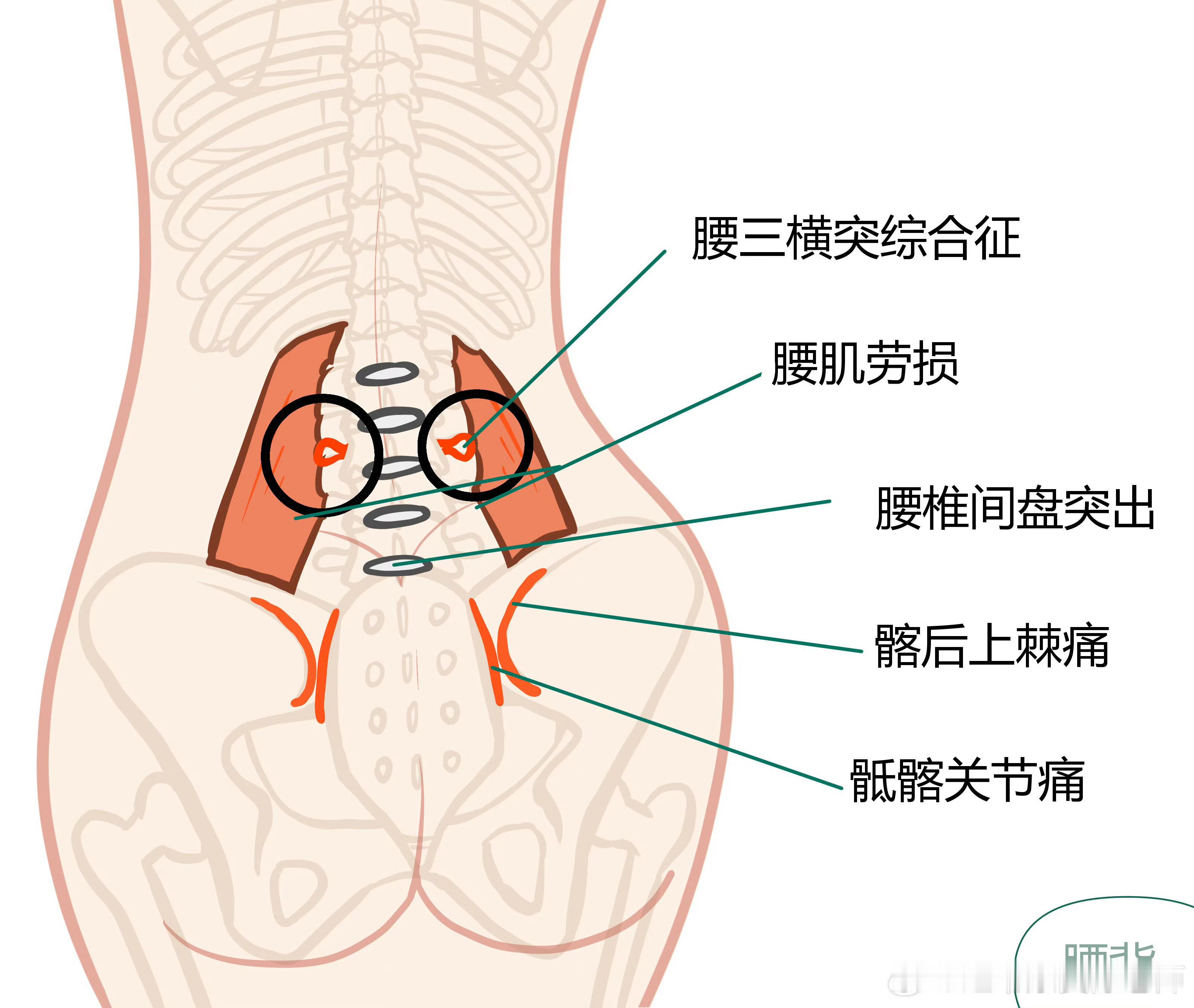 腰痛康复腰肌劳损、腰椎间盘突出、骶髂关节、筋膜炎……腰痛永远都是高频问题，特