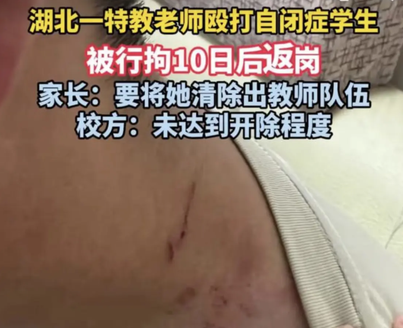 湖北恩施，特教老师被17岁自闭症男学生抓住头发后，情急反击被拘10日，出来后学生