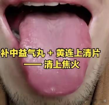 补中益气丸+黄连上清片：巧治气虚火盛，补清兼顾不偏颇大家好，我是陈大夫！