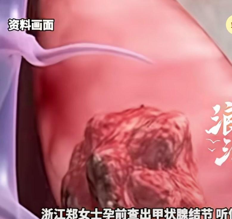 怀孕吃错盐影响孩子一生，孕妈为控制甲状腺结节，长期吃无碘盐，导致两岁女儿发育迟