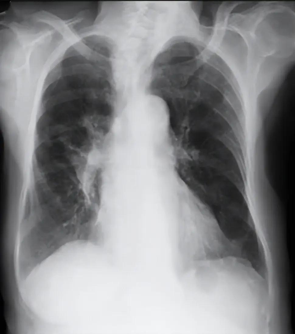 2026年1月，58岁关先生因胸背痛疑心梗送医，却被东莞康华医院外科医生误诊为“