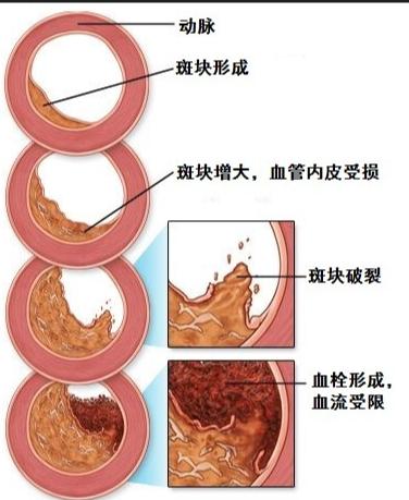 你以为那些毫无征兆倒下的人，都是被命运突然抽走了生命吗？错了。绝大多数猝死，尤其