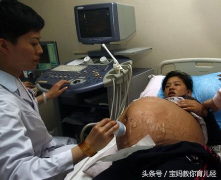 37岁孕妇孕3月肚大如8月, 医生检查说是多胞胎, 听完数字全家人高兴不起来
