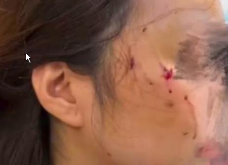 女子被养2年猫攻击致颅部3级损伤女子被养2年猫攻击致颅部3级损伤陈女士是一位经