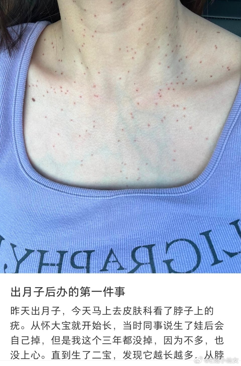 看到唐艺昕说产后之所以这么久不怎么拍戏是因为严重皮肤病，我听描述感觉最可能是神经