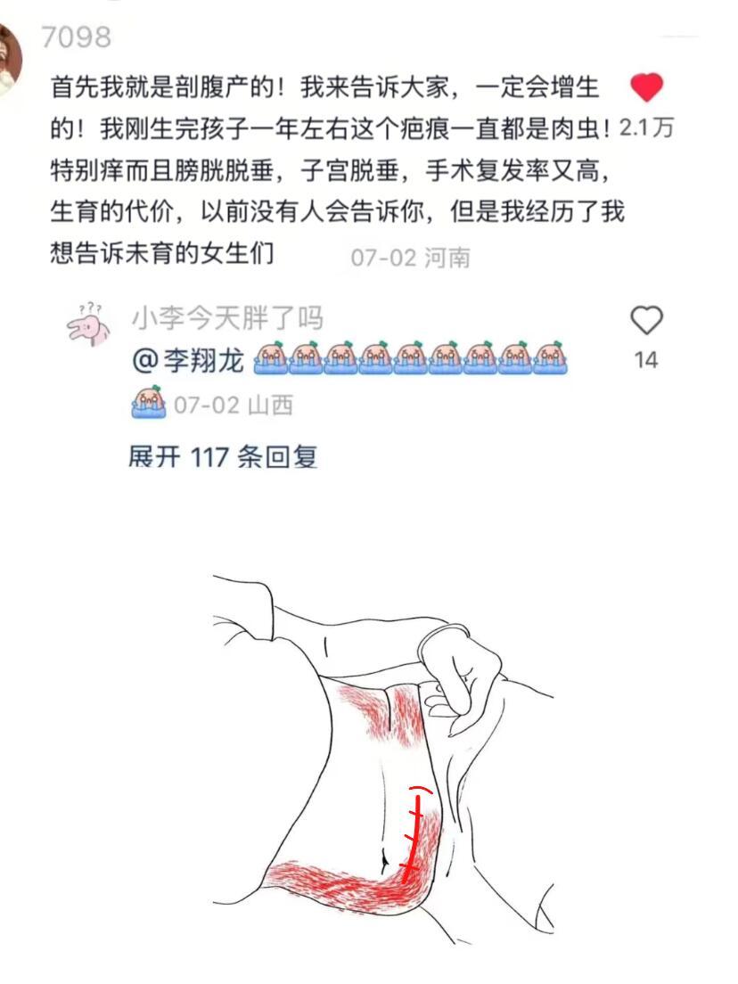 第一次被剖腹产的冷知识重创​​​