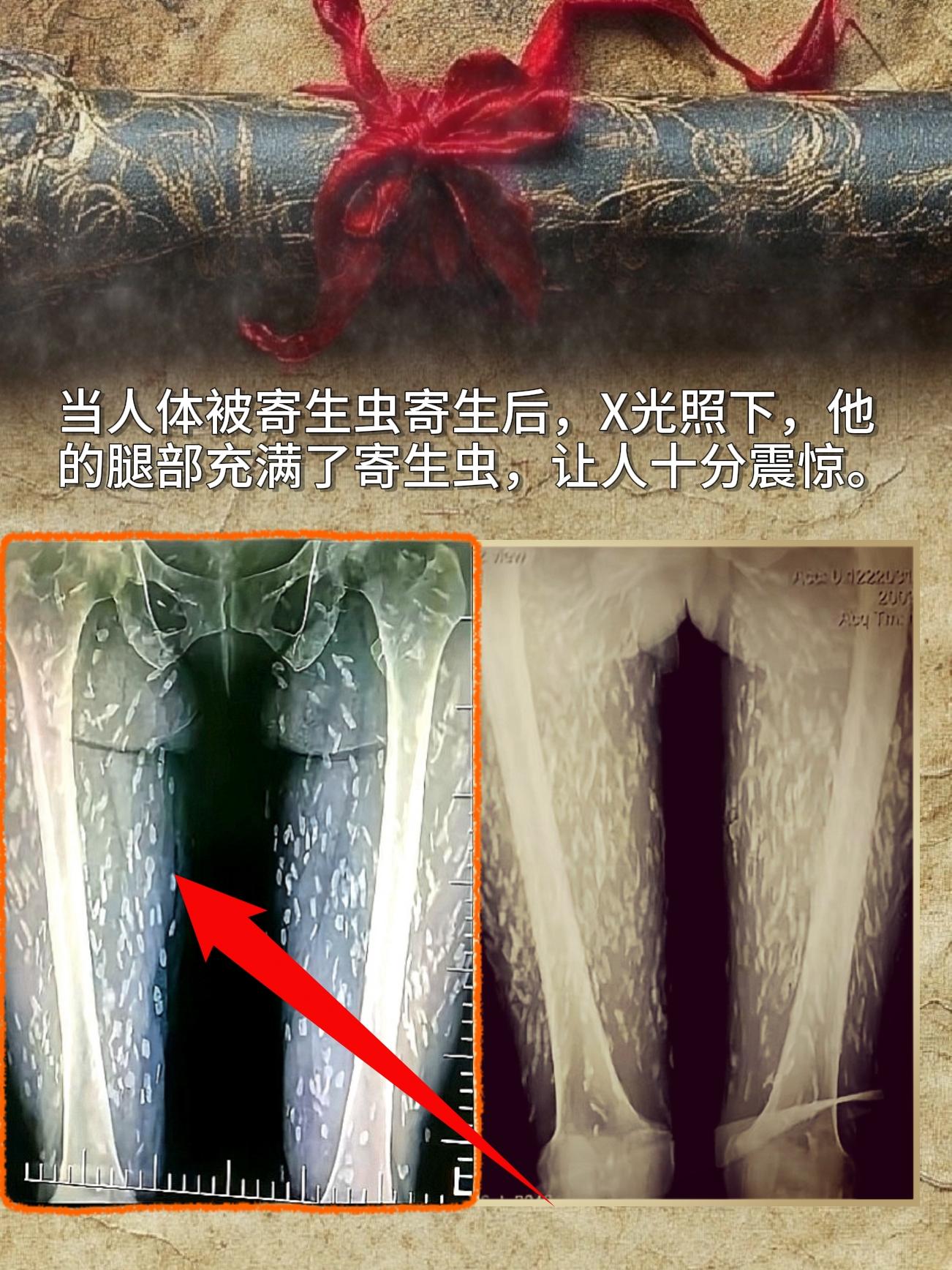 当人体被寄生虫寄生后，X光照下，他的腿部充满了寄生虫，让人十分震惊。