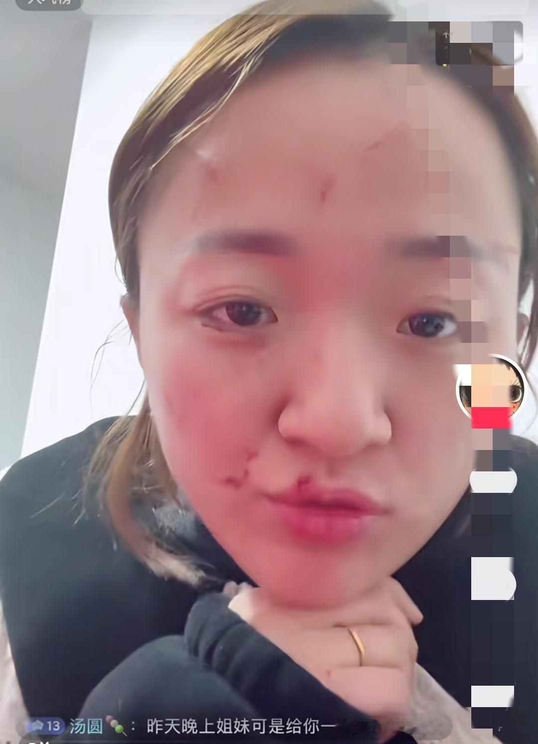 宁波这桩家事，5万买断的是心死​​儿媳被婆婆挠得满脸血印，5万块钱了结，一家人