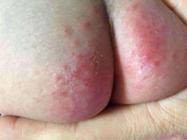 宝宝得了红屁股, 别用激素药膏了, 教你一个绿色疗法