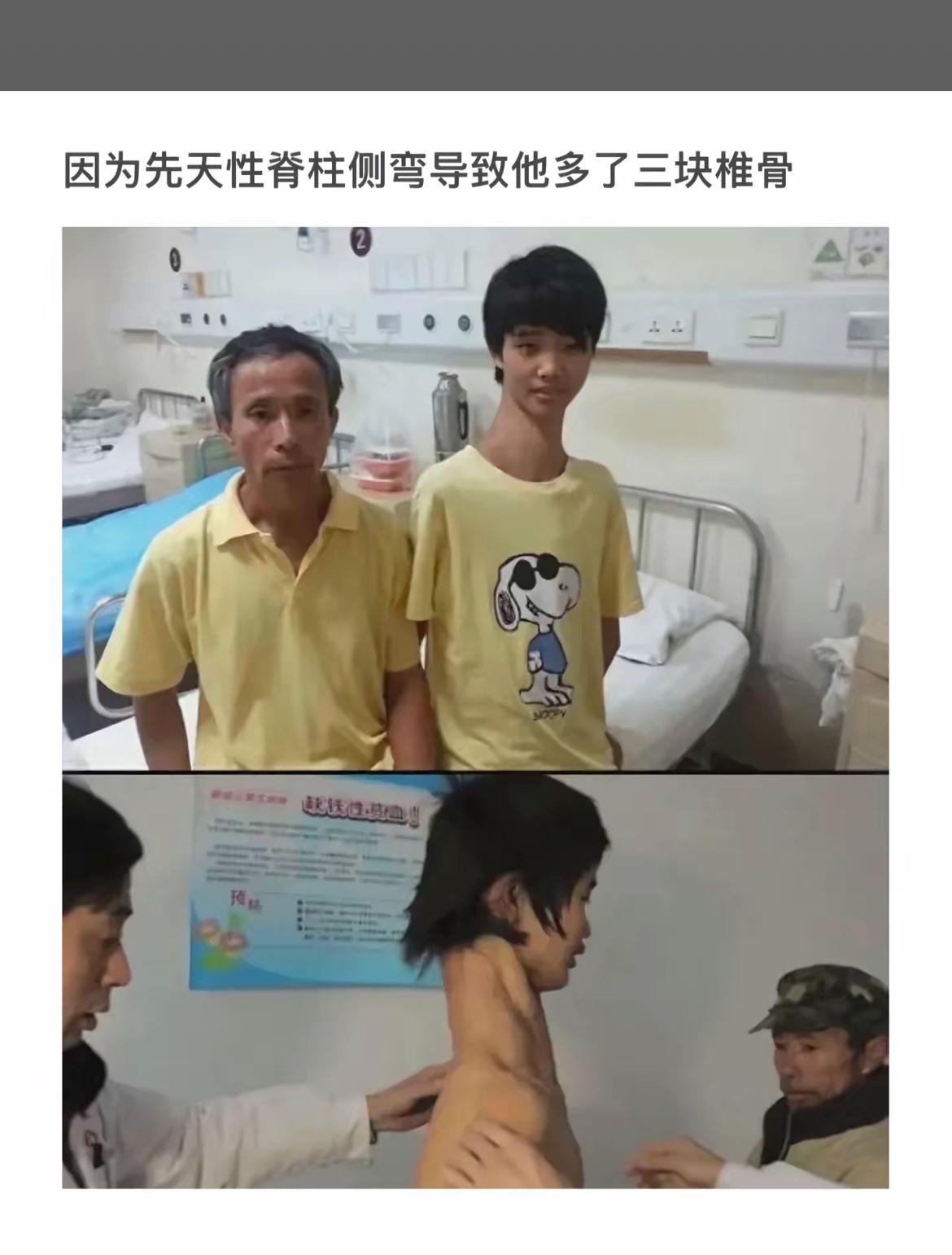 先天性脊柱侧弯导致他多了三块椎骨，医生检查中...