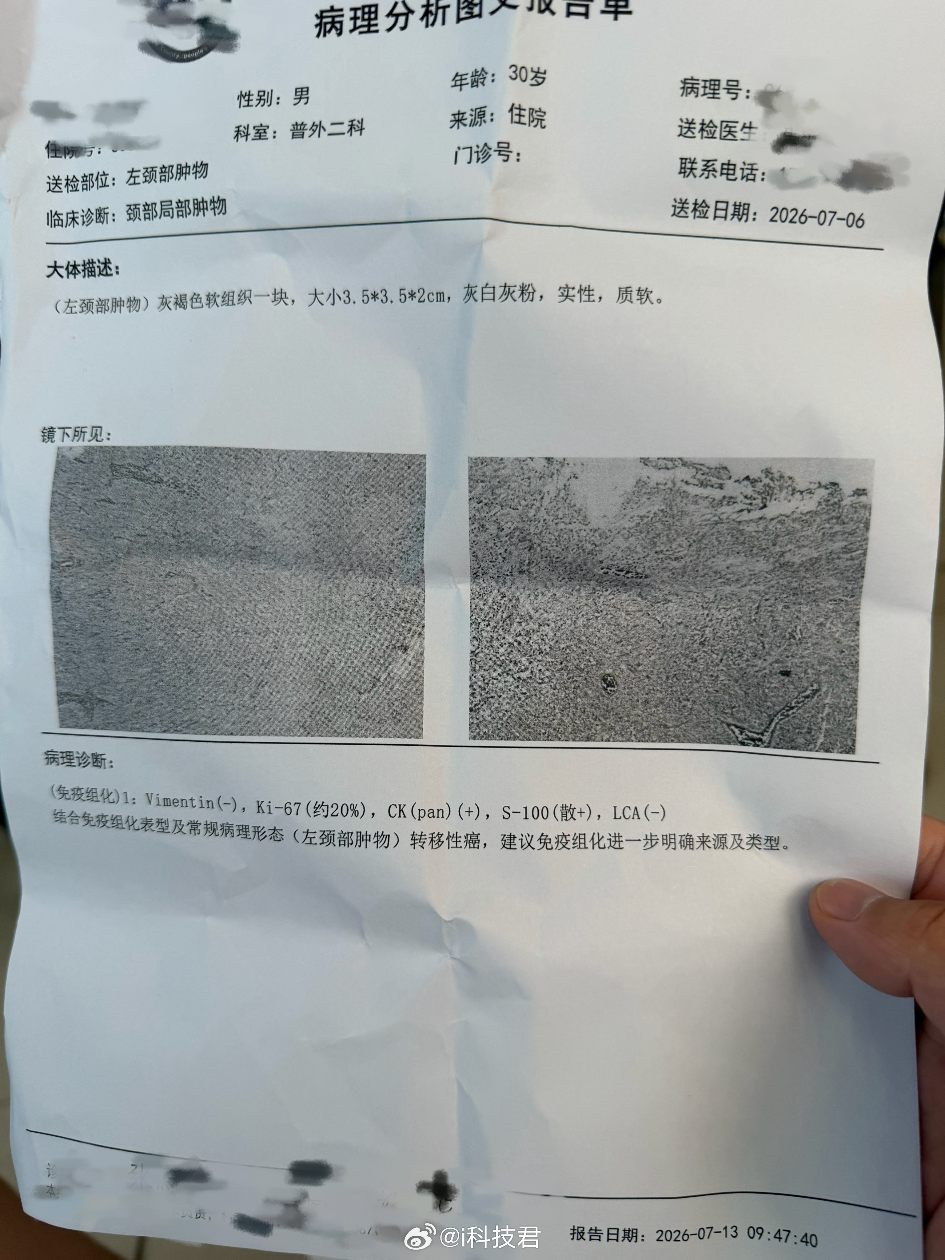 唉，颈部肿物手术做了一周后，去医院拆线完成了，割下来的疙瘩化验结果出来了，说是转