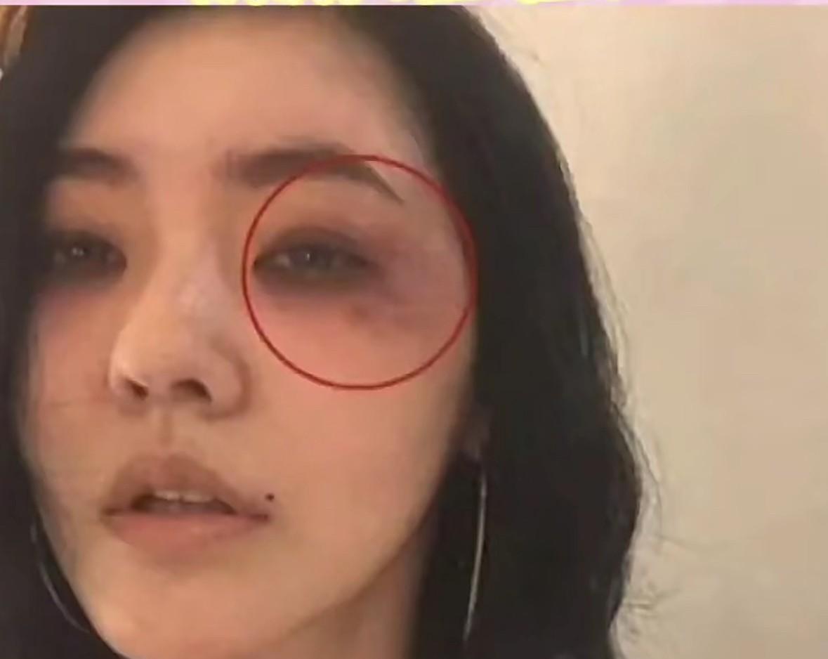 小s怎么了，眼睛好像被打了。前天看到的图片，不知道是啥时候的事。昨天又看到一个
