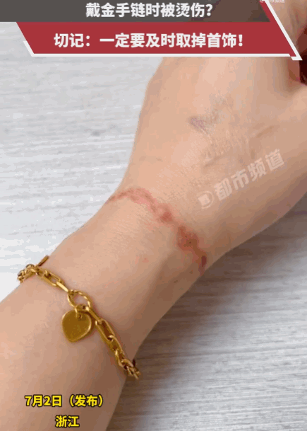 万万没想到！浙江，一女子戴着金手链时，不慎将滚烫的热水洒在了手臂上。起初，整片皮