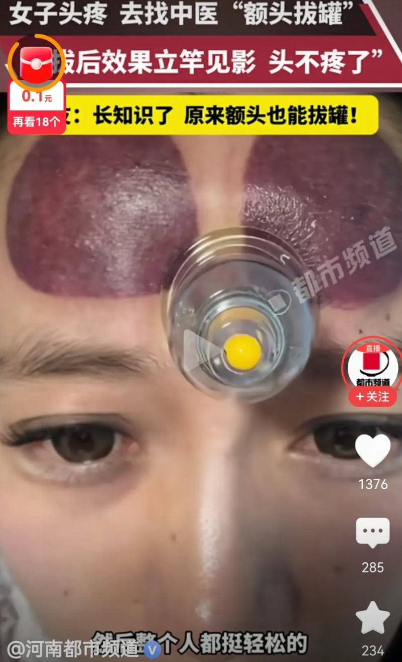 女子因头痛去看医生，医生给她脑门上拔罐，女子觉得拔完罐之后整个人都很轻松不头疼了