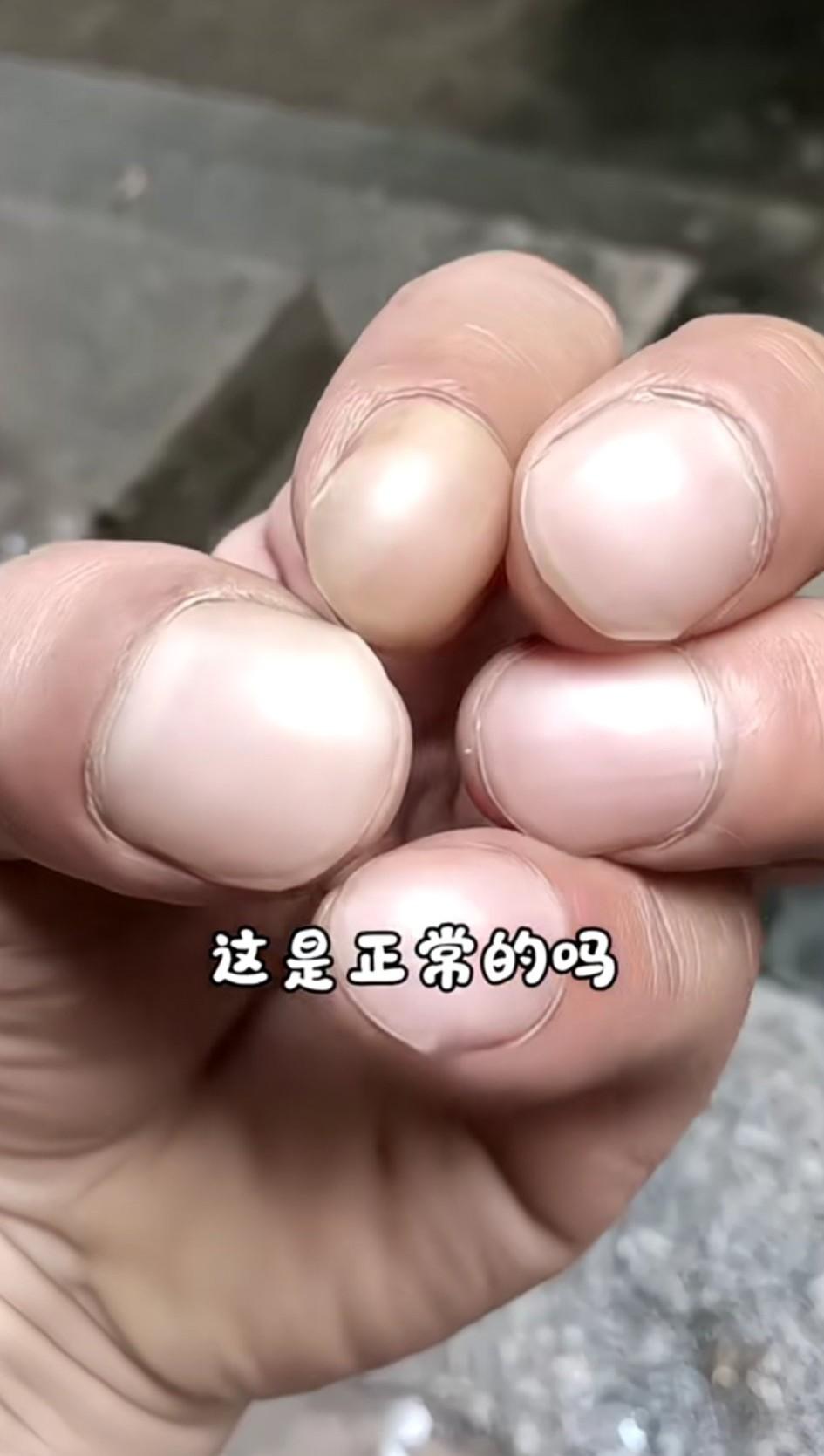 家人们谁懂呀，我发现工友的指甲盖圆鼓鼓的，看着怪奇怪的。你们有谁知道这是啥原因吗