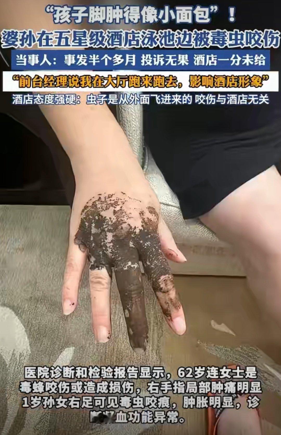 1岁孩子住美高梅酒店被毒虫咬伤这手肿成这样，看着就疼，酒店介么横哇[doge]，