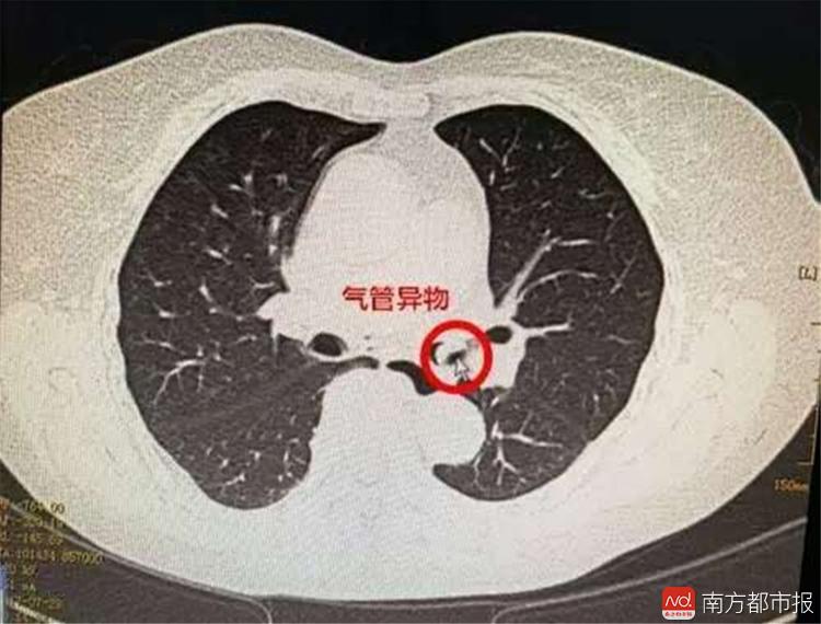就有可能顺着声门溜进气管,轻者引起咳嗽,重者,还会出现肺脓肿,肺穿孔